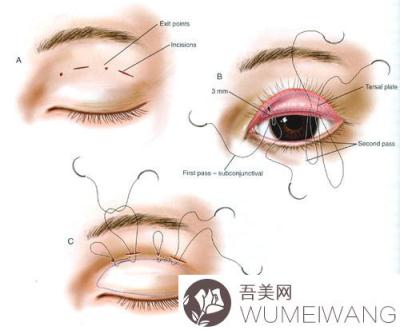 纳米微创翘睫双眼皮术后有什么果