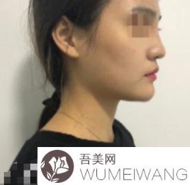 北京中日友好医院整形科薛志强简介和做鼻子案例一览
