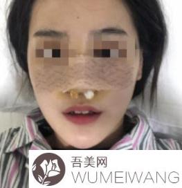 北京中日友好医院整形科薛志强简介和做鼻子案例一览