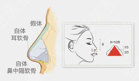 分段式假体隆鼻1.jpg