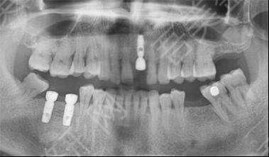 种植牙案例图.jpg