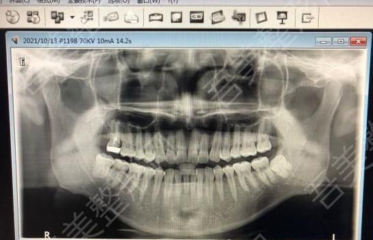 种植牙2 (2).jpg