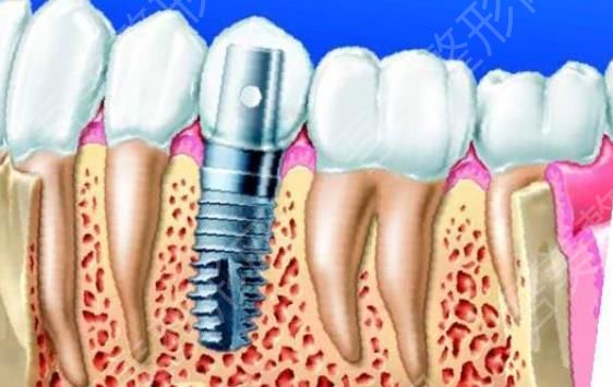 牙齿种植h05.jpg