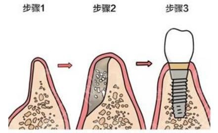 种植牙齿5.jpg