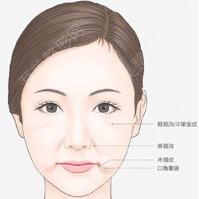 口角囊袋3 衰老 问题 下垂.jpg