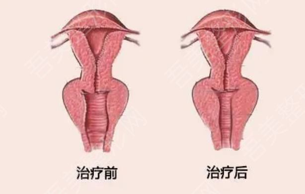 缩阴手术动漫01.jpg