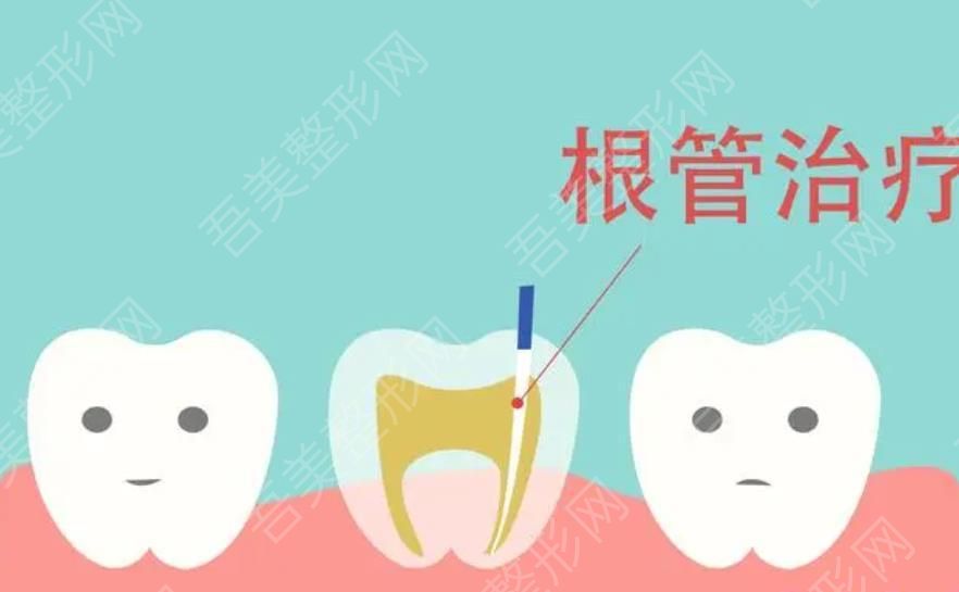 牙齿根管治疗卡通图01.jpg