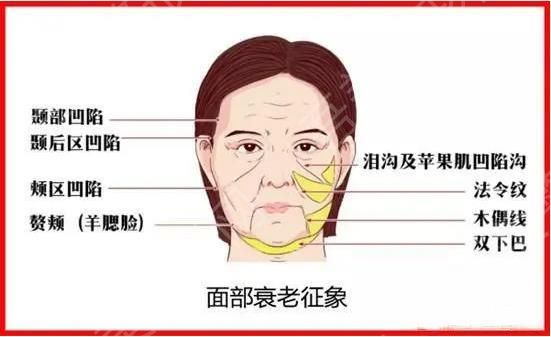 衰老 除皱 下垂 问题 拉皮 轮廓.jpg