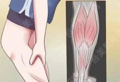小腿肌肉酸痛是怎么回事啊？如何缓解呢？戳进来看！