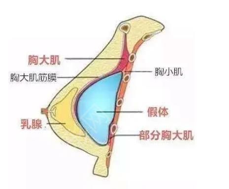 脂肪隆胸21.jpg