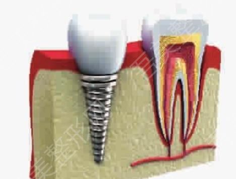 牙齿种植hg89.jpg