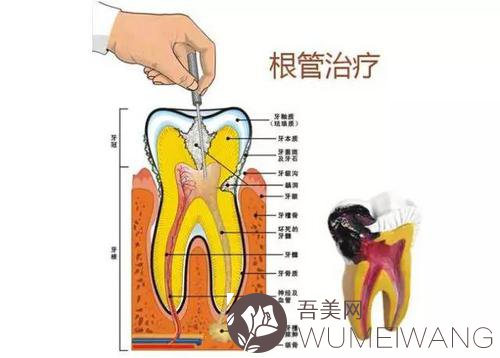 牙髓炎根管调节费用