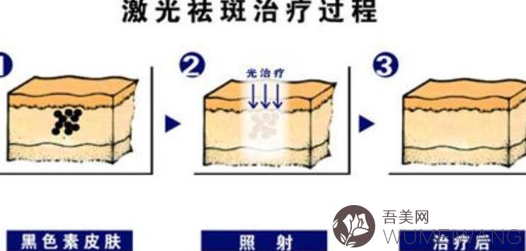 激光祛斑的价格一般是多少