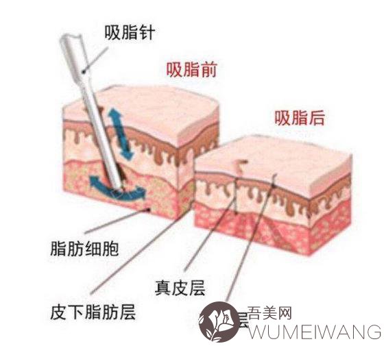 水动力吸脂多少钱？