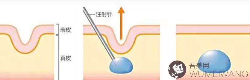 泪沟填充价格多少钱