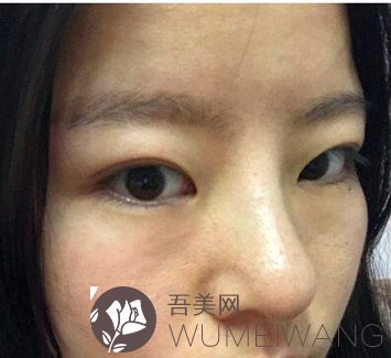 北京八大处双眼皮修复案例