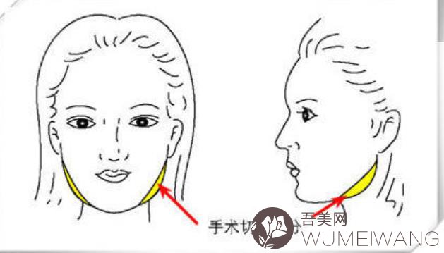 下颌角切除费用多少钱