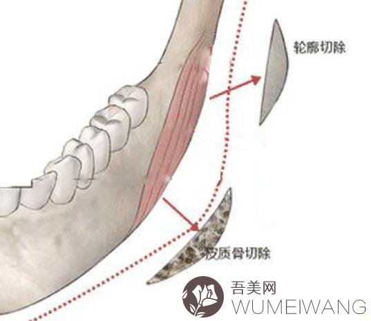 下颌角切除费用多少钱