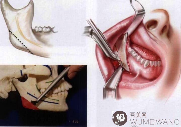 下颌角切除费用多少钱