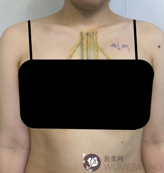 上海第九人民医院美容科假体隆胸案例