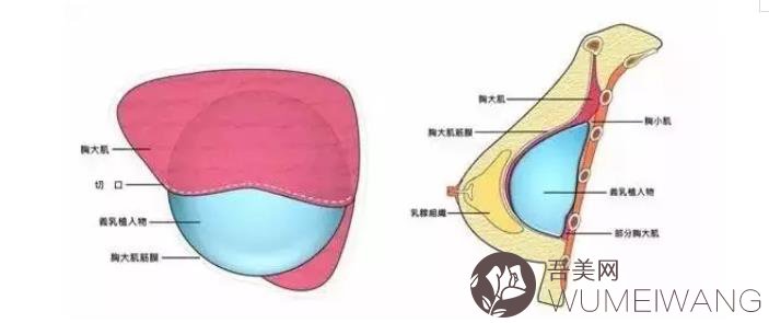 假体丰胸失败修复价格