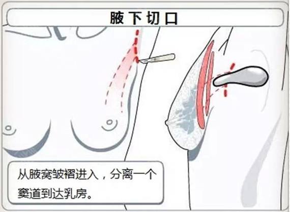 科普假体隆胸相关知识