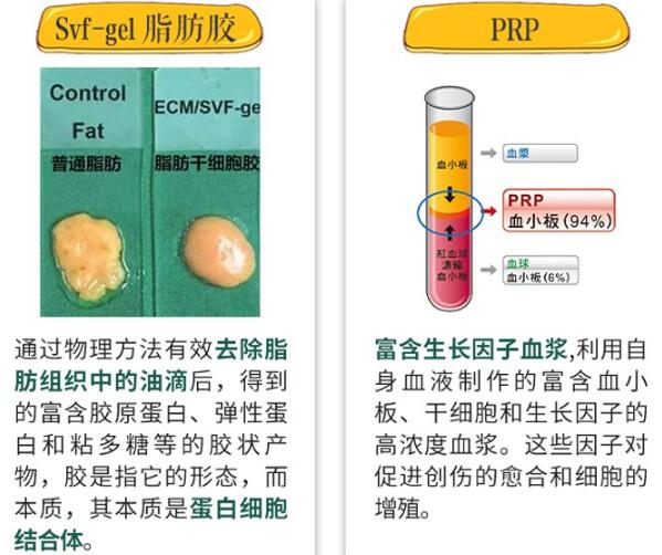 自体脂肪注射式隆胸手术科普