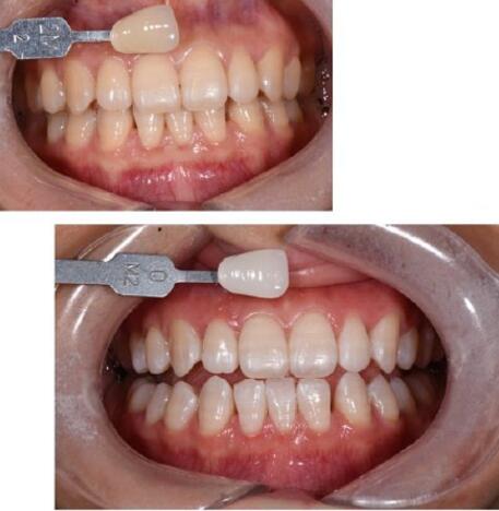 冷光美白牙齿的果图分享