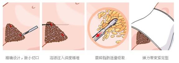 北京协和整形外科赵茹医生科普吸脂手术