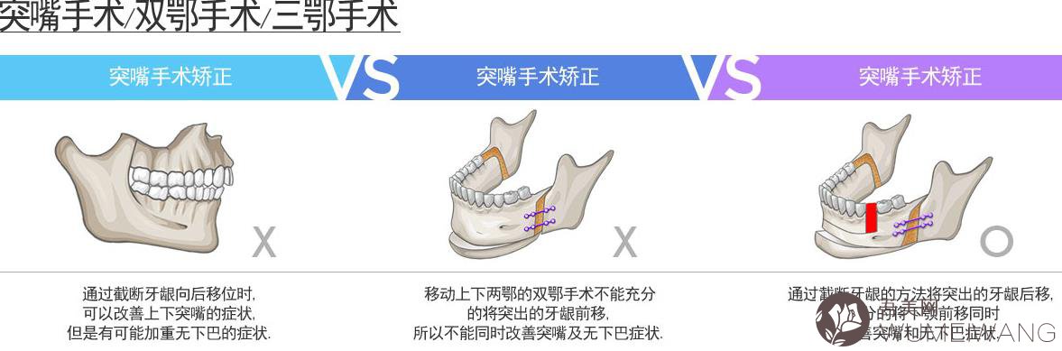 双鄂手术