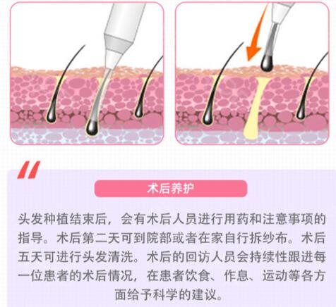 种植头发手术前提前准备和手术后常见问题