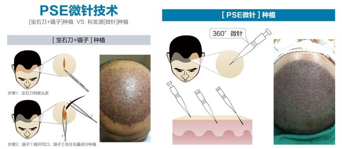 脱发解决好办法：植发手术