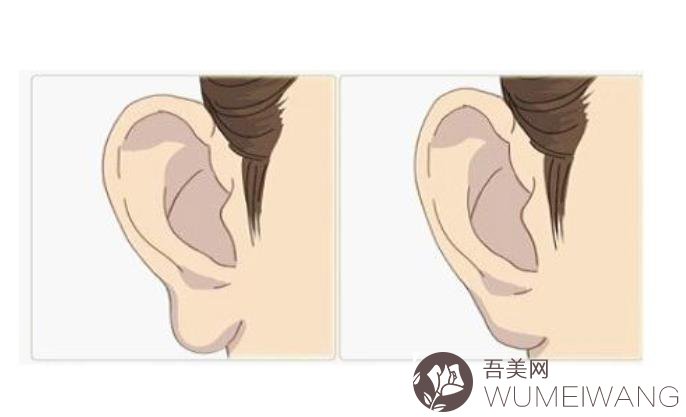 耳朵整形的较佳年龄是多少?