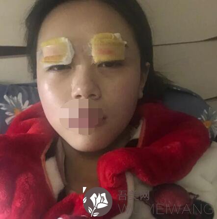 重庆新桥医院双眼皮整形手术后一周