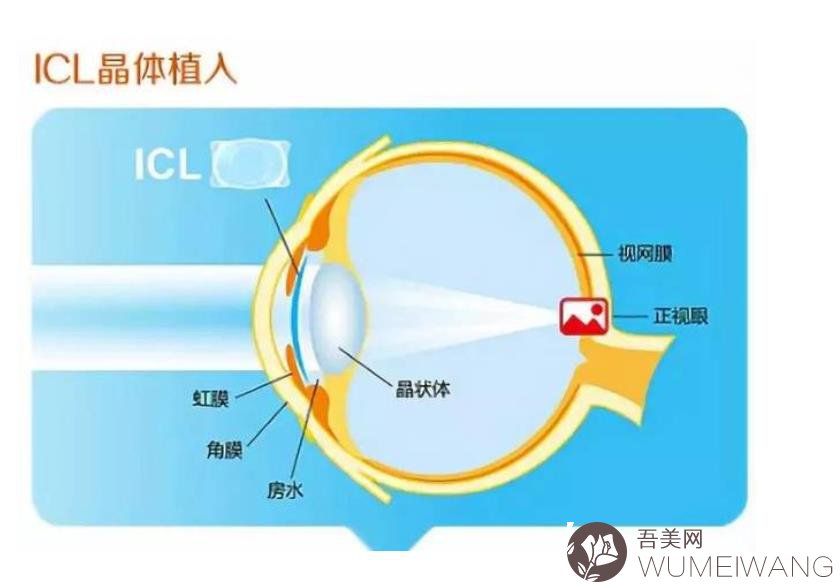 .ICL晶体的植入