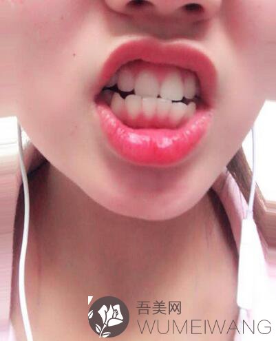 重庆地区牙齿矫正果图