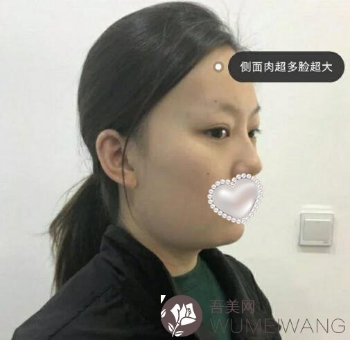 达州熙之医学美容诊所双下巴吸脂案例