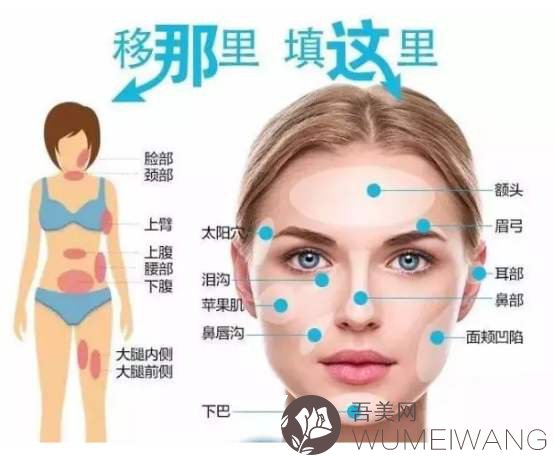 上海诺诗雅医疗美容医院陈小伟自体脂肪填充介绍