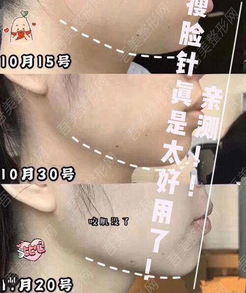 四川省人民医院注射瘦脸果图