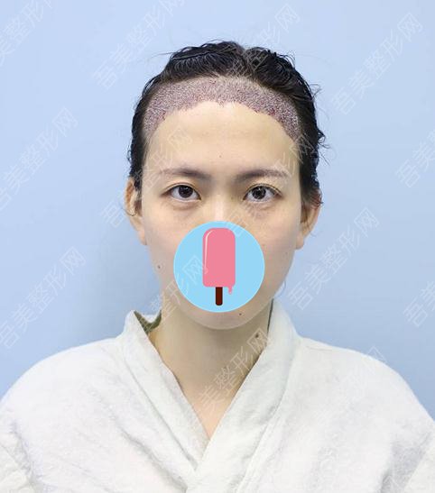 重庆新生医疗美容门诊部植发案例