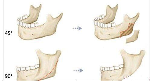 李安平医生介绍下颌角整形