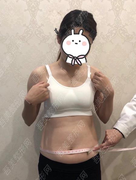 张敬德医生腰部吸脂案例分享:术前