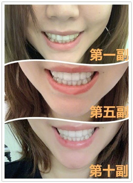 广州瑞德口腔医院牙齿矫正案例分享