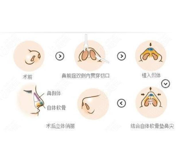 上海同德医院美容科鼻小柱整形科普