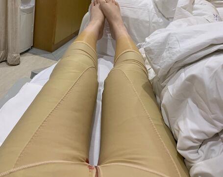重庆时光整形美容医院大腿抽脂案例分享