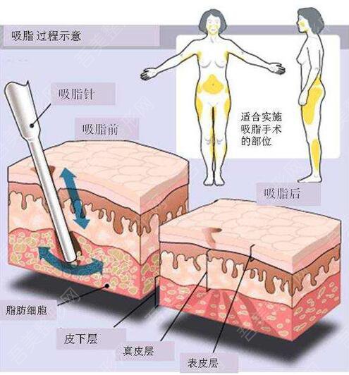 吸脂手术示意图