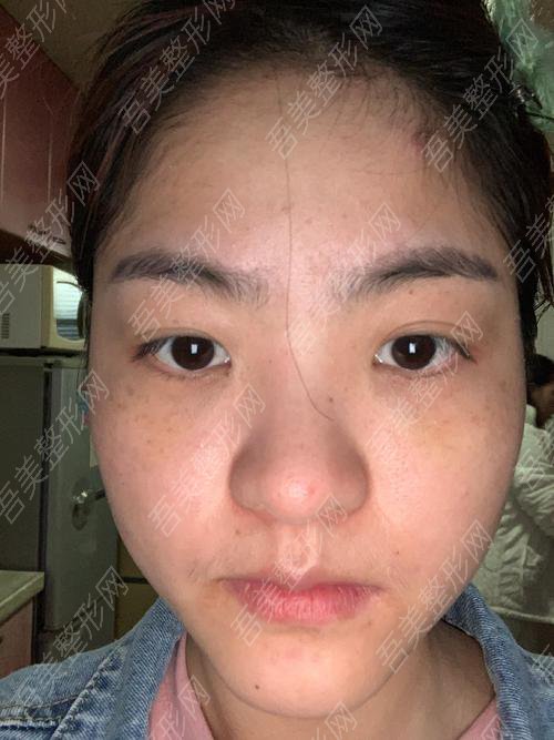 北京新面孔医疗美容诊所超声波黑眼圈去除案例分享:术前
