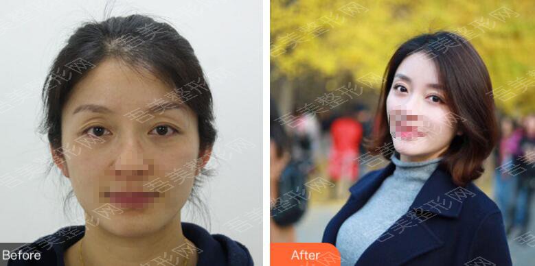 上海九院整形外科眼修复案例分享