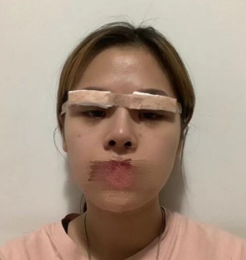 杨亚益医生双眼皮修复案例分享