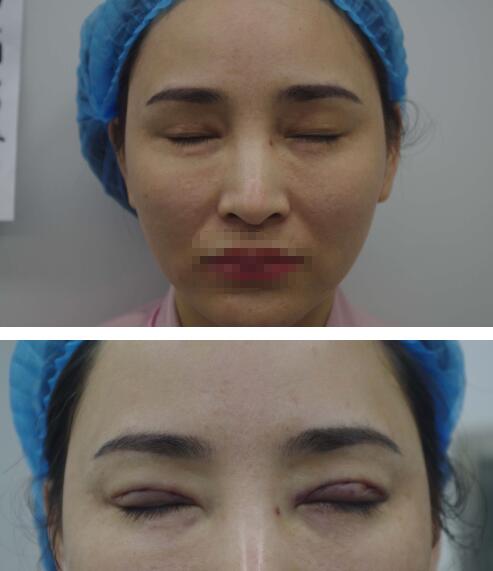 北京延世医疗美容金奇龙医生双眼皮修复案例分享